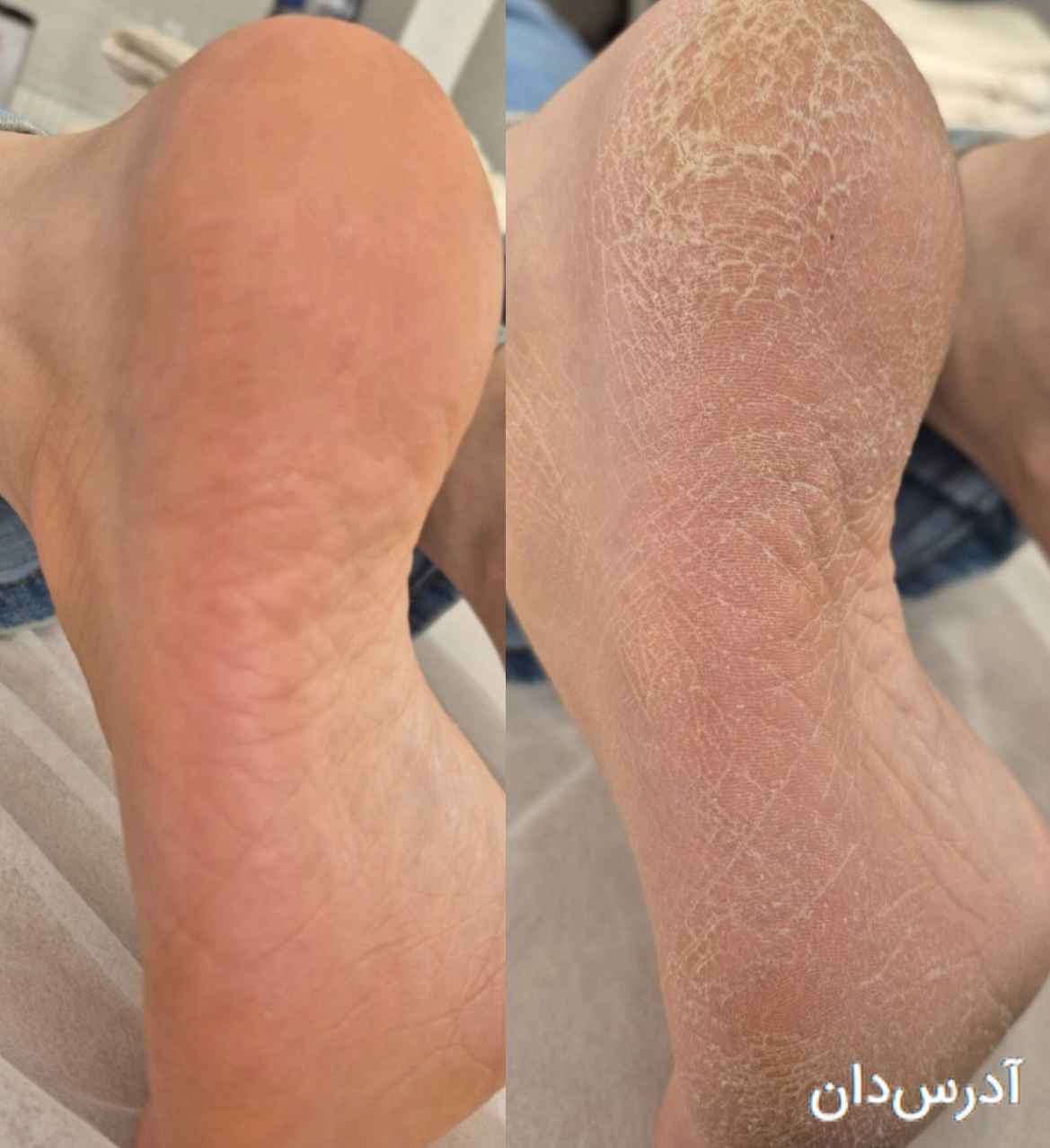 پدیکور کفسابی